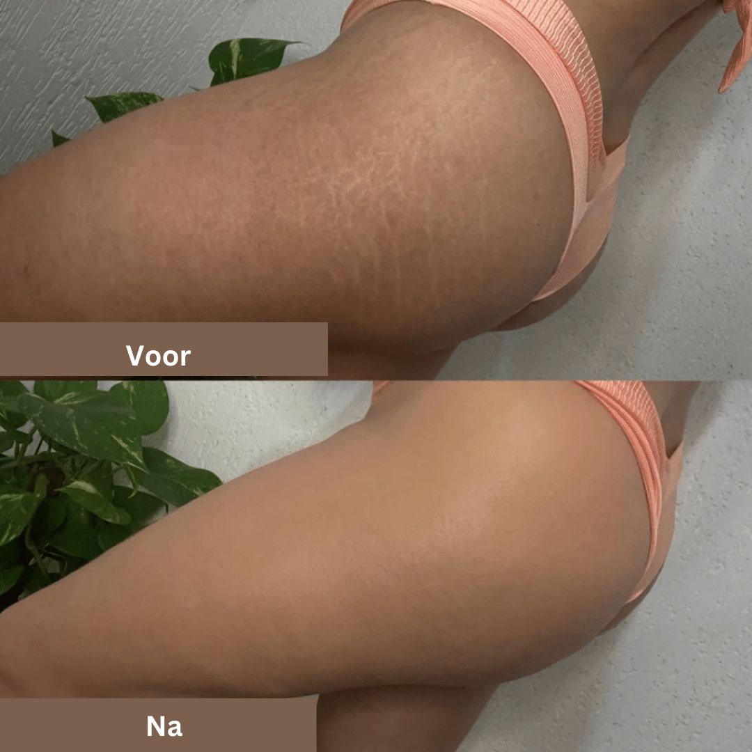 Før og efter billede af lår med strækmærker, der viser hudforbedring. Effektiv behandling mod strækmærker. Hudpleje, skønhed, resultater.