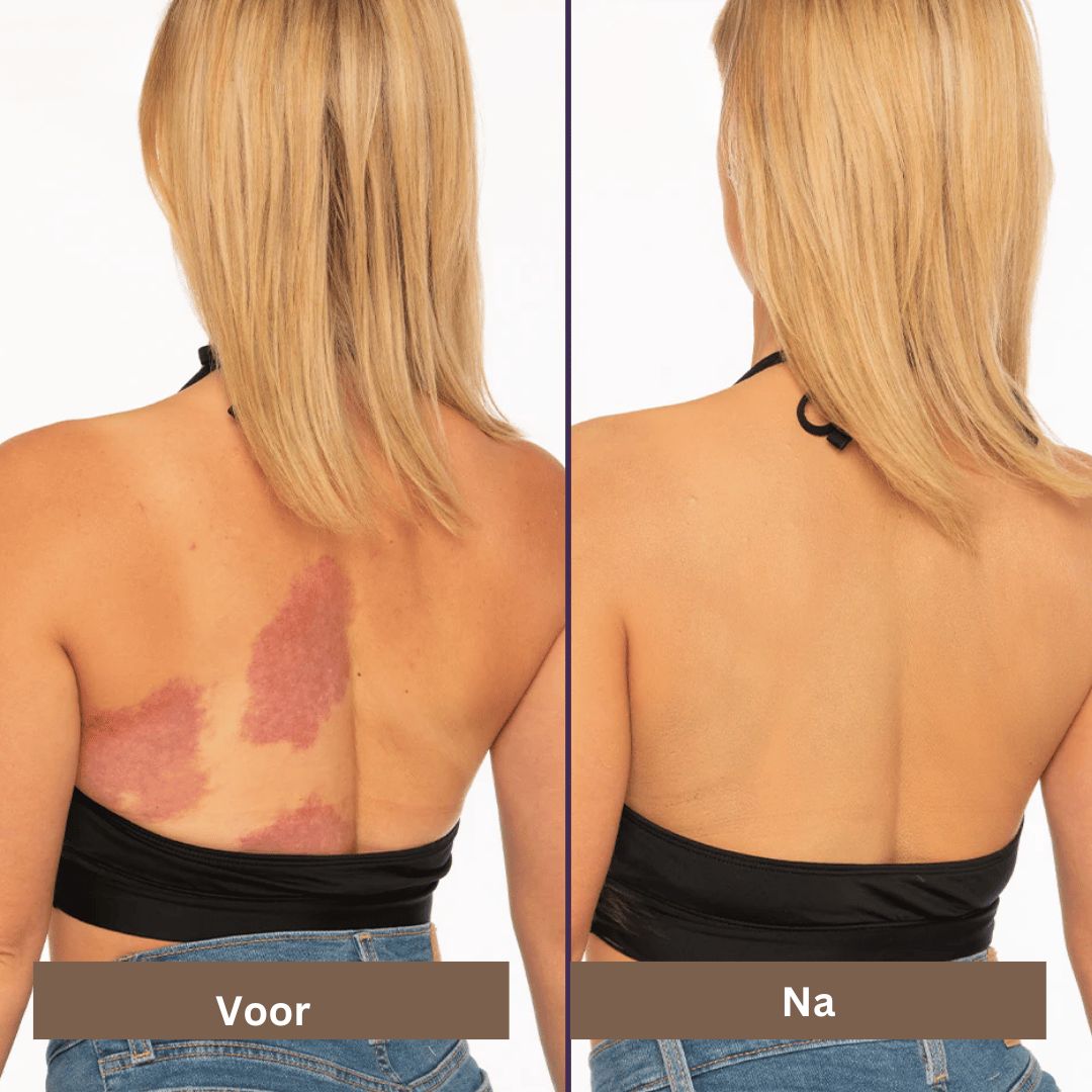 Kvindes ryg før og efter laserbehandling mod modermærke, viser effektiv fjernelse. Hudpleje, skønhedsbehandling, før-efter resultater.